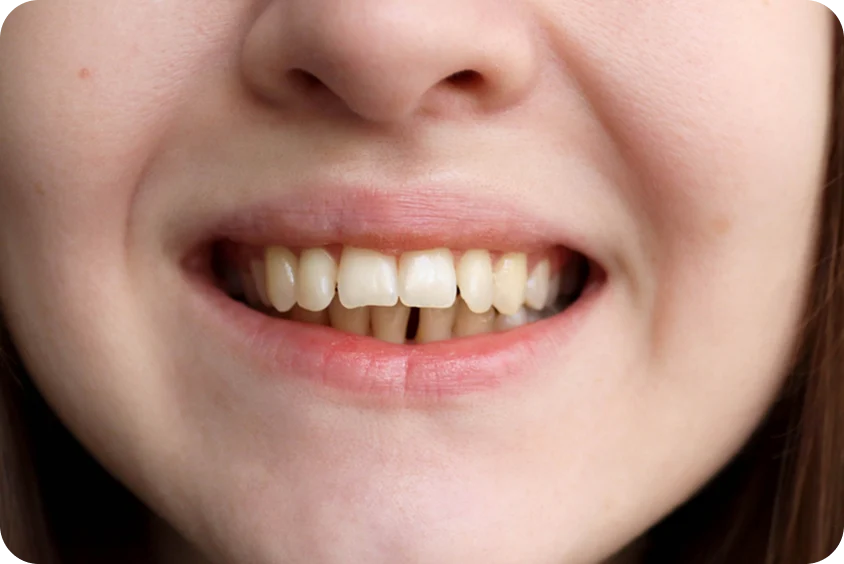 Overbite Front Ready to Treat Your Overbite With Caspersmile Clear Aligners