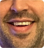 After treatment