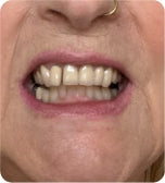After treatment
