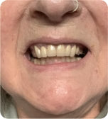 Before treatment