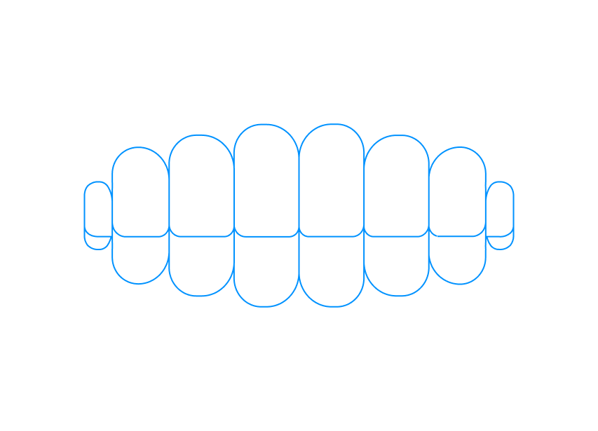 What is Overbite?