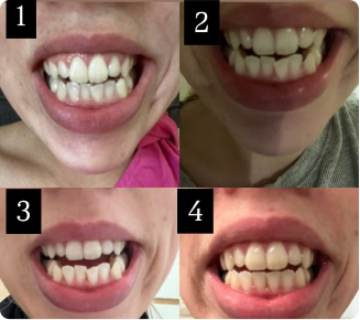 So happy with my new smile!