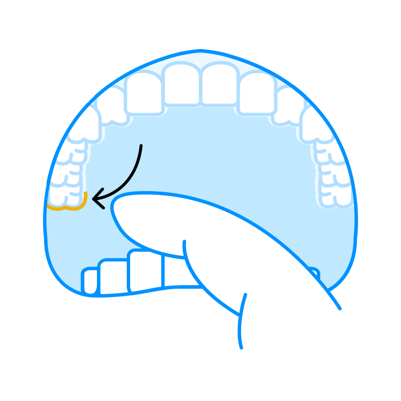 How to remove clear aligners-3