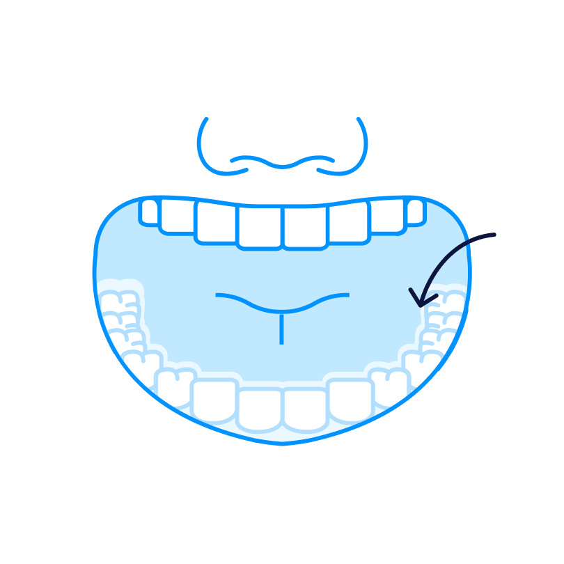 How to remove clear aligners-6