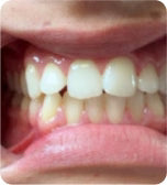 Before treatment